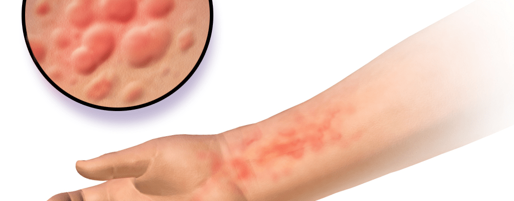 8 věcí, které byste měli vědět o planých neštovicích