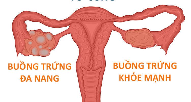 Kan en kvinna med polycystisk äggstock bli gravid?