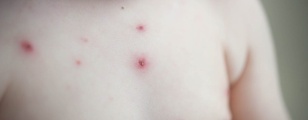 Jaké jsou komplikace planých neštovic u dětí?